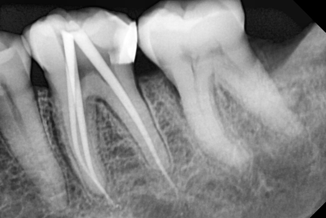 Periapical Radiography – Scan4Dent