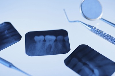 Dental instruments and x-rays